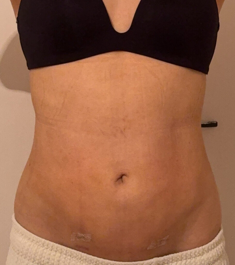 お腹の脂肪吸引