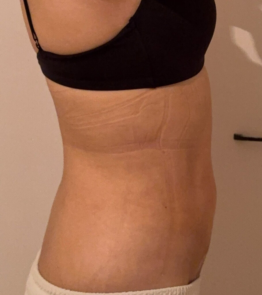 お腹の脂肪吸引