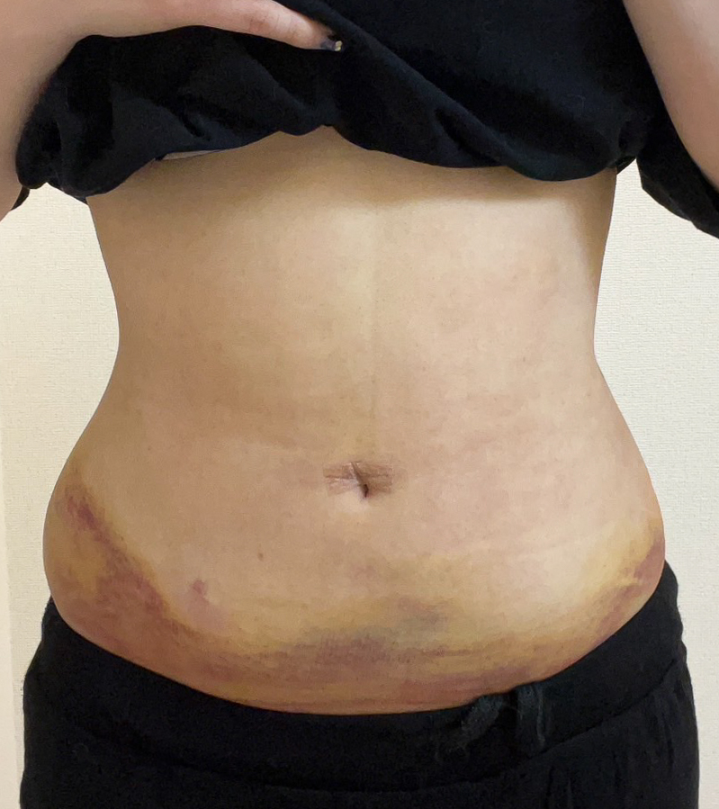 お腹の脂肪吸引