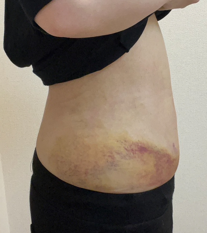 お腹の脂肪吸引