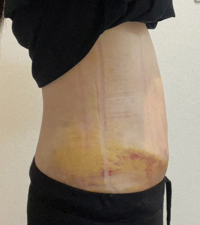 お腹の脂肪吸引