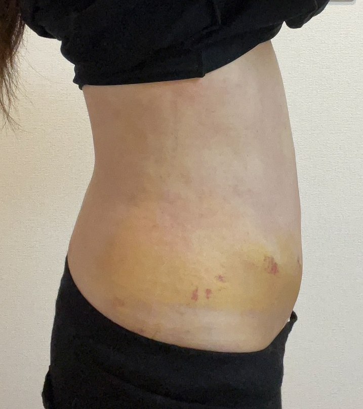 お腹の脂肪吸引