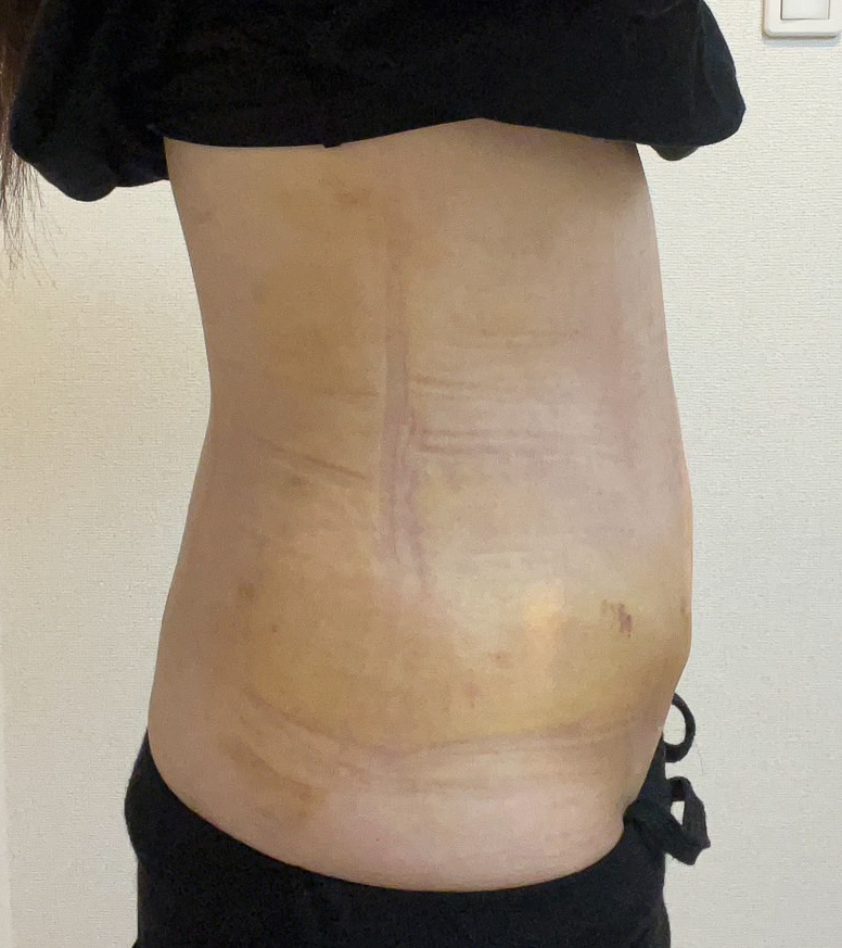 お腹の脂肪吸引