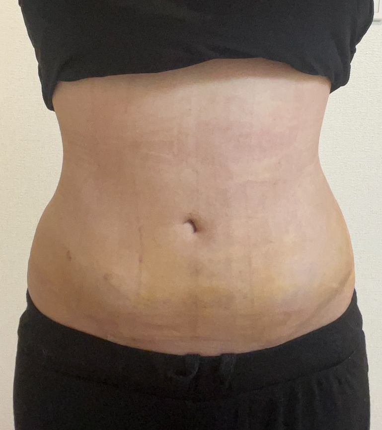 お腹の脂肪吸引