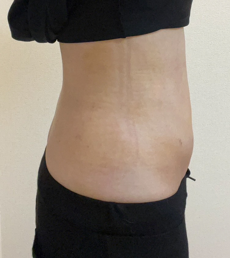 お腹の脂肪吸引