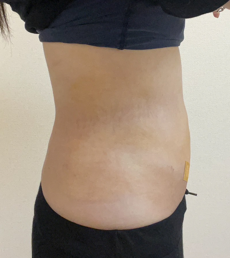 お腹の脂肪吸引