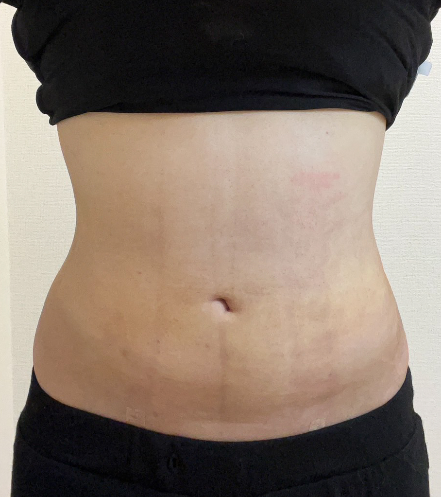 お腹の脂肪吸引