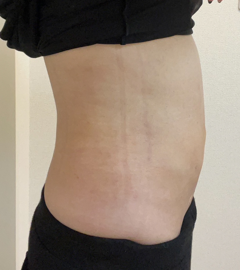 お腹の脂肪吸引