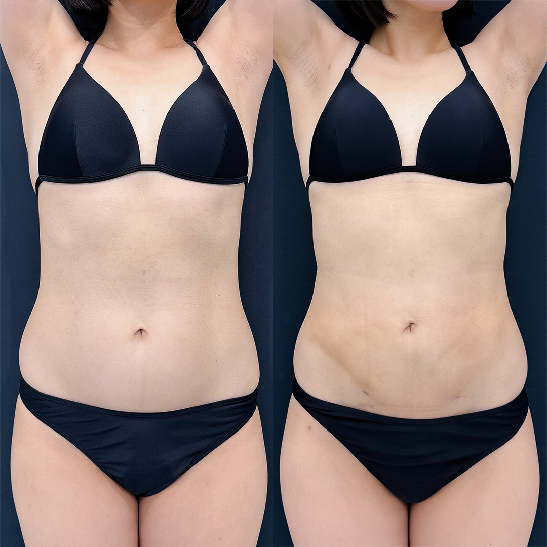 お腹の脂肪吸引