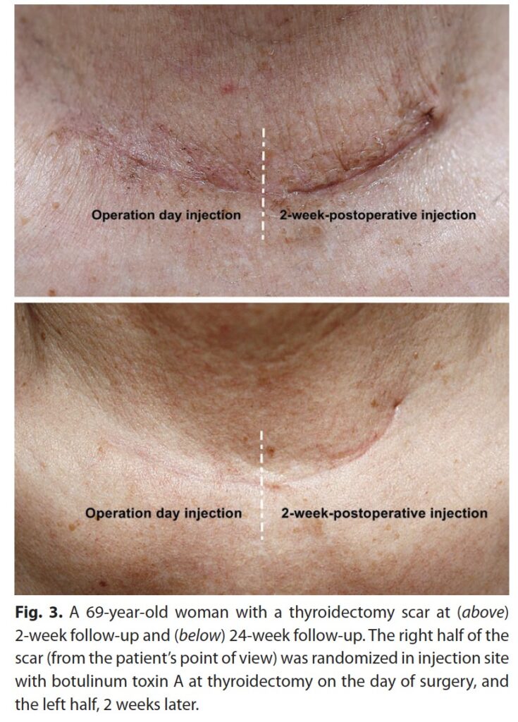 傷跡ボトックス