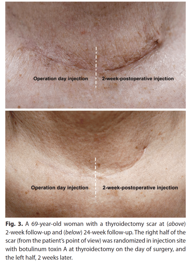 傷跡ボトックス