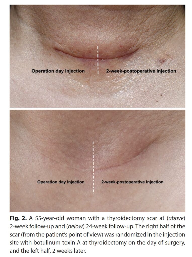 傷跡ボトックス