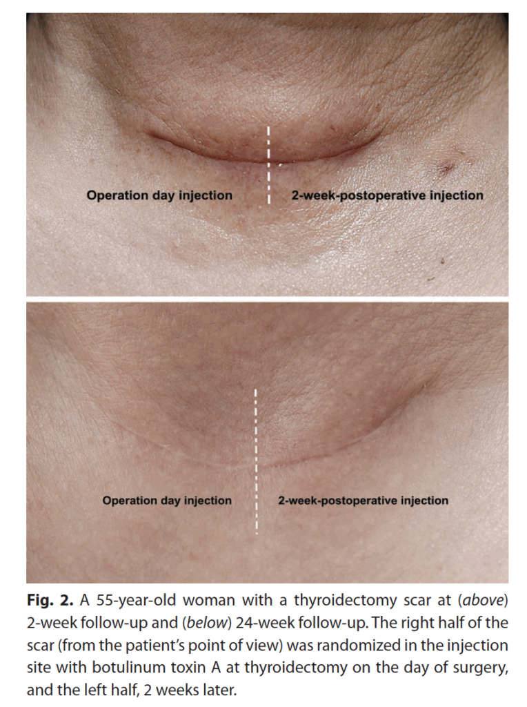 傷跡ボトックス