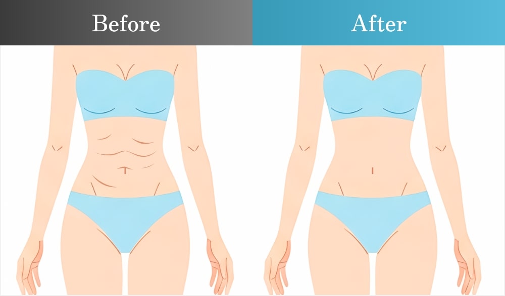 脂肪吸引の失敗事例と修正方法