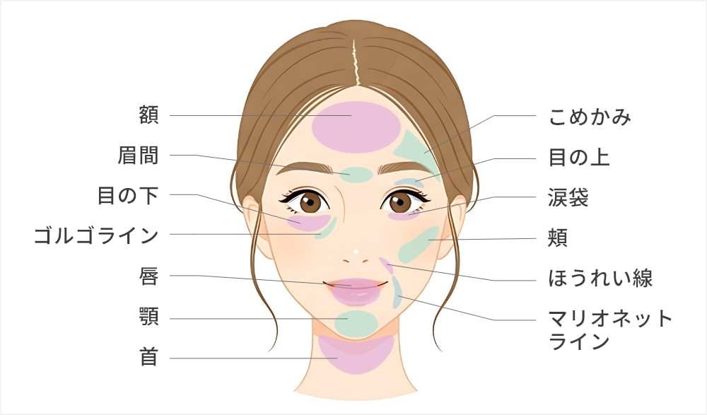 顔の脂肪注入の施術箇所