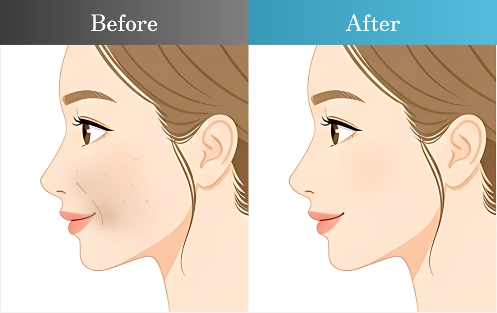 肌質の改善とシワの軽減