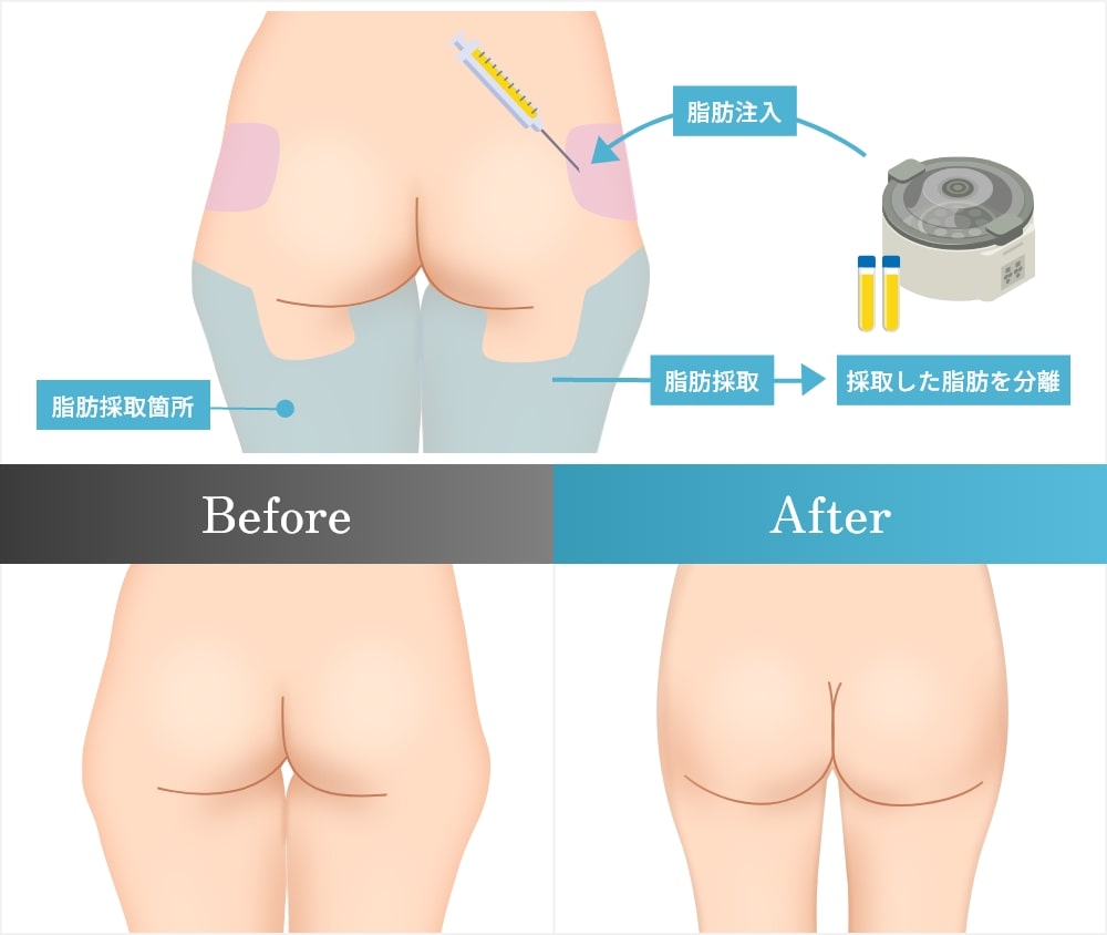 足の引き締めと滑らかなヒップラインの形成