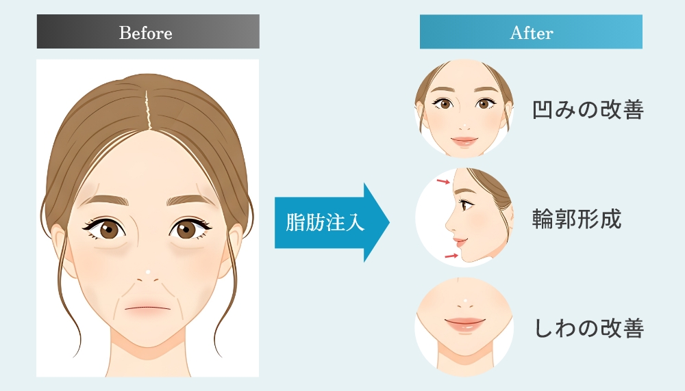 フェイスラインの引き締めとハリ感の向上