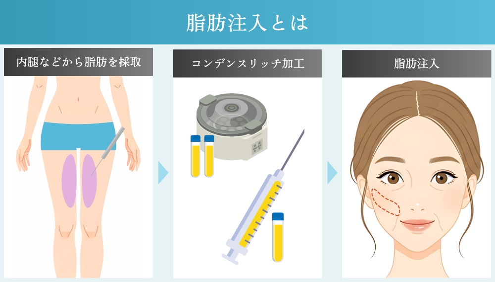 脂肪注入とは