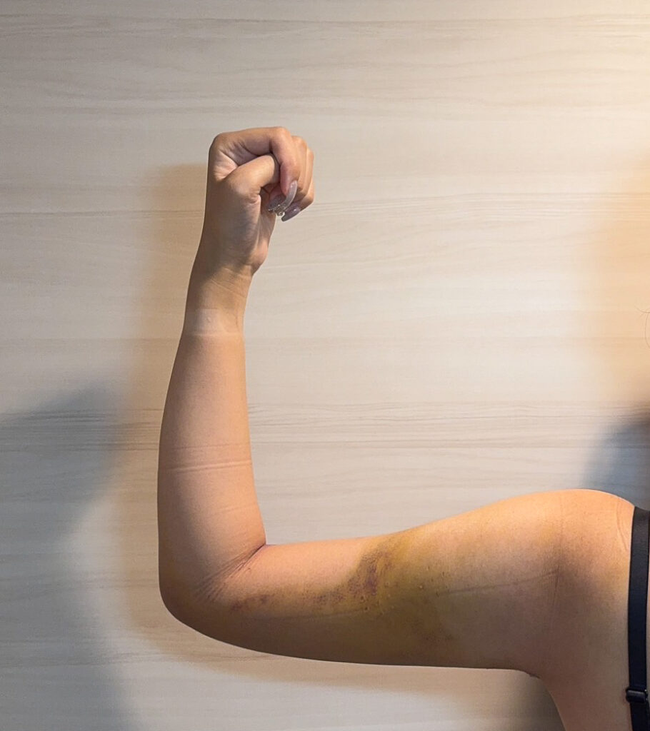 二の腕の脂肪吸引