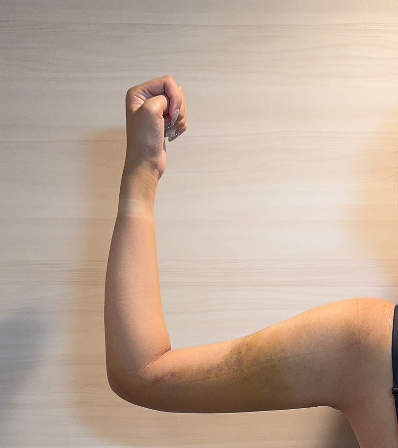 二の腕の脂肪吸引