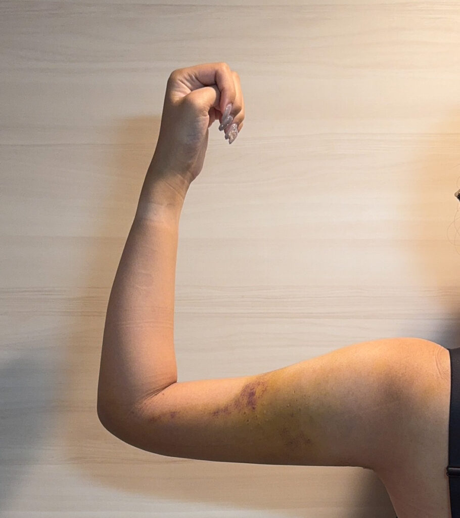 二の腕の脂肪吸引