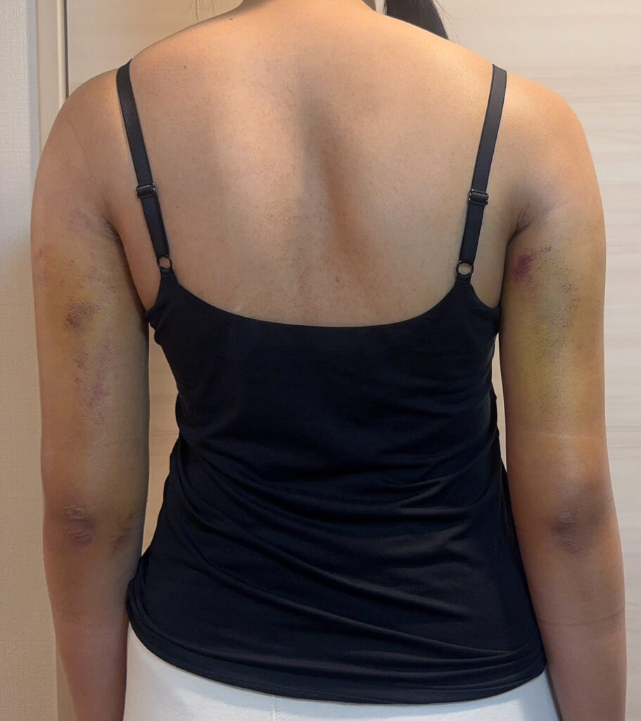 二の腕の脂肪吸引