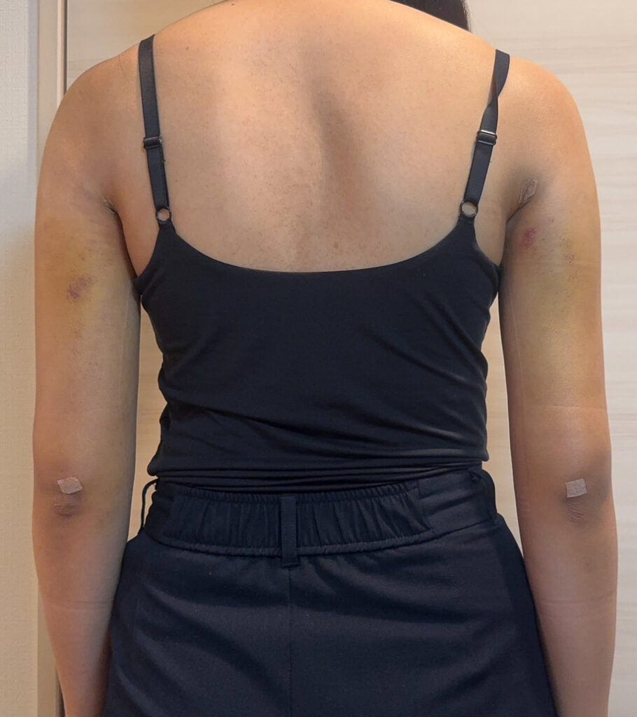 二の腕の脂肪吸引