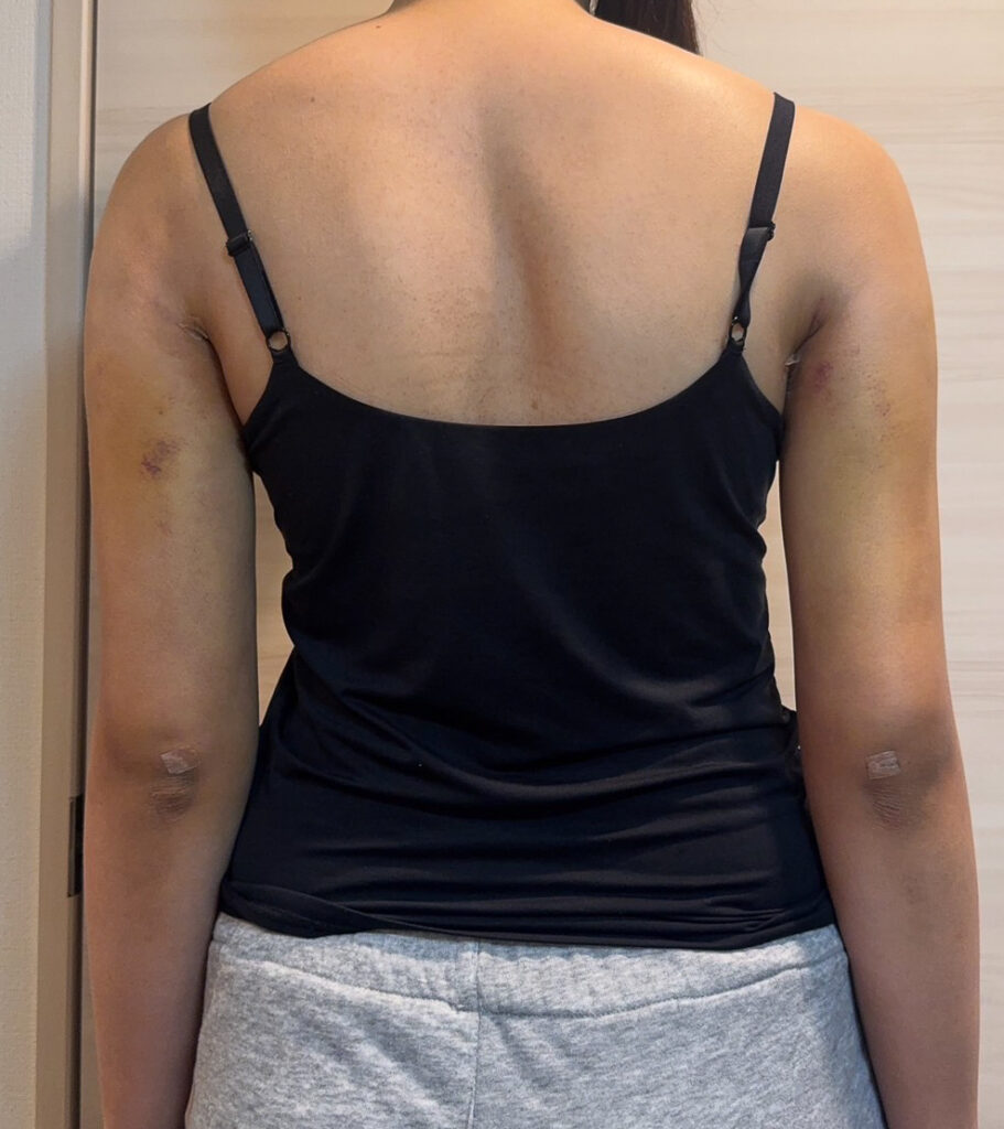 二の腕の脂肪吸引