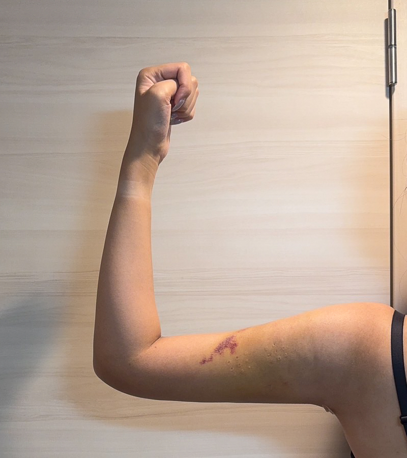 二の腕の脂肪吸引