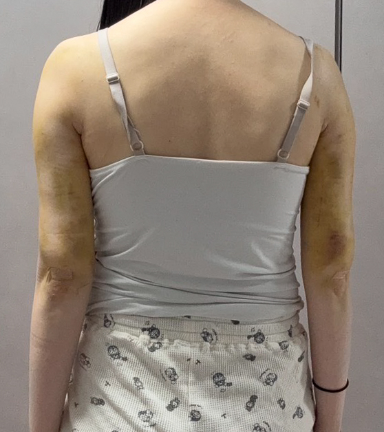 二の腕の脂肪吸引