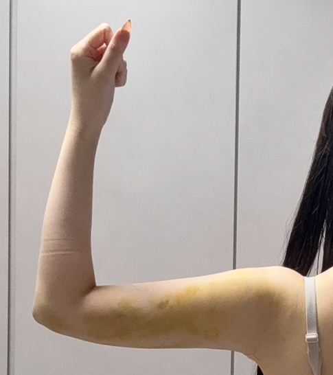 二の腕の脂肪吸引