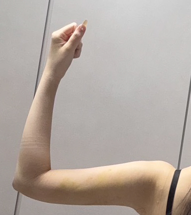 二の腕の脂肪吸引