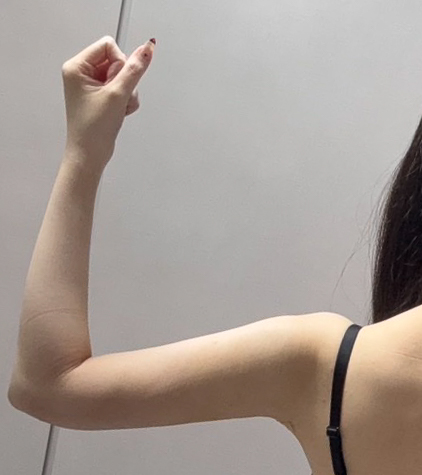 二の腕の脂肪吸引