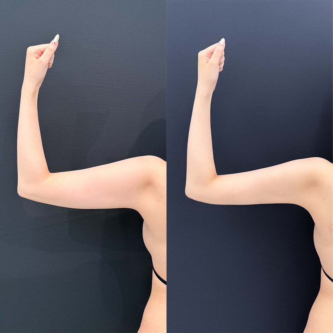 https://purelys-tokyo-clinic.com/wp/wp-content/uploads/2025/11/arm-Liposuction_Case-No.154.jpg