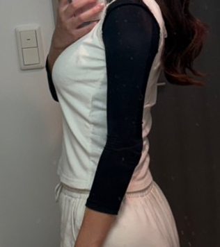 二の腕の脂肪吸引