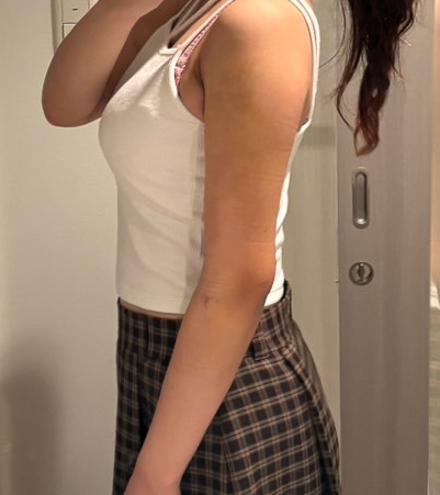 二の腕の脂肪吸引