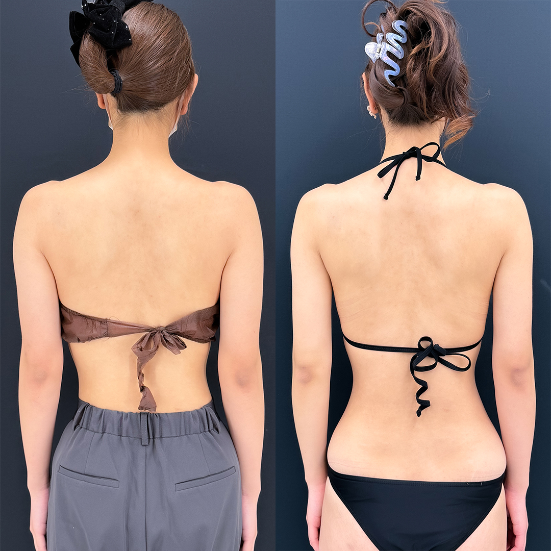 二の腕の脂肪吸引