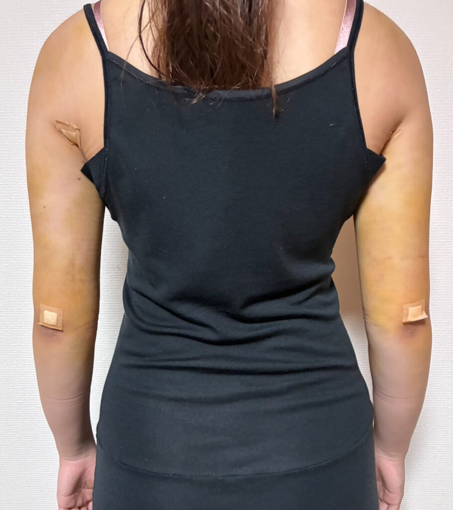 二の腕の脂肪吸引