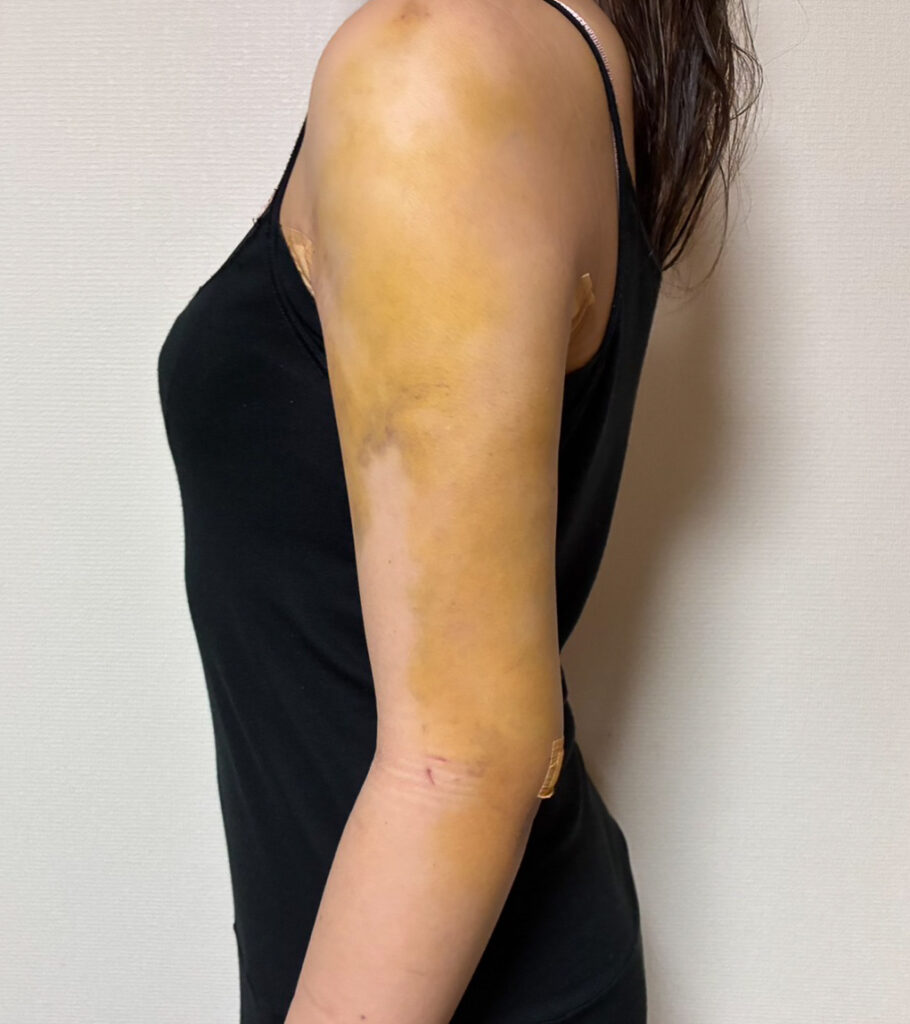 二の腕の脂肪吸引