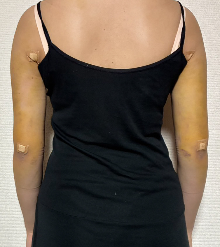 二の腕の脂肪吸引