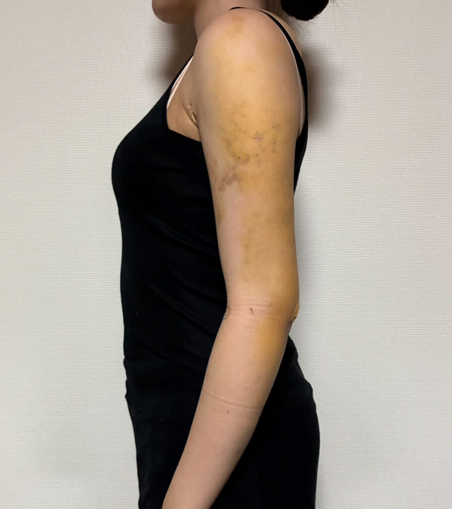 二の腕の脂肪吸引