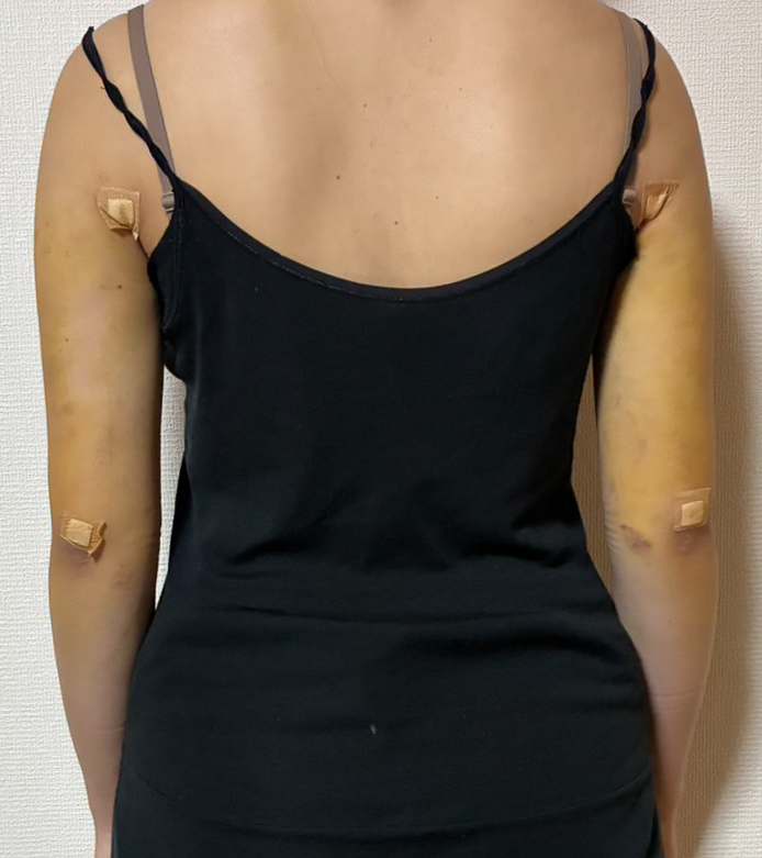 二の腕の脂肪吸引