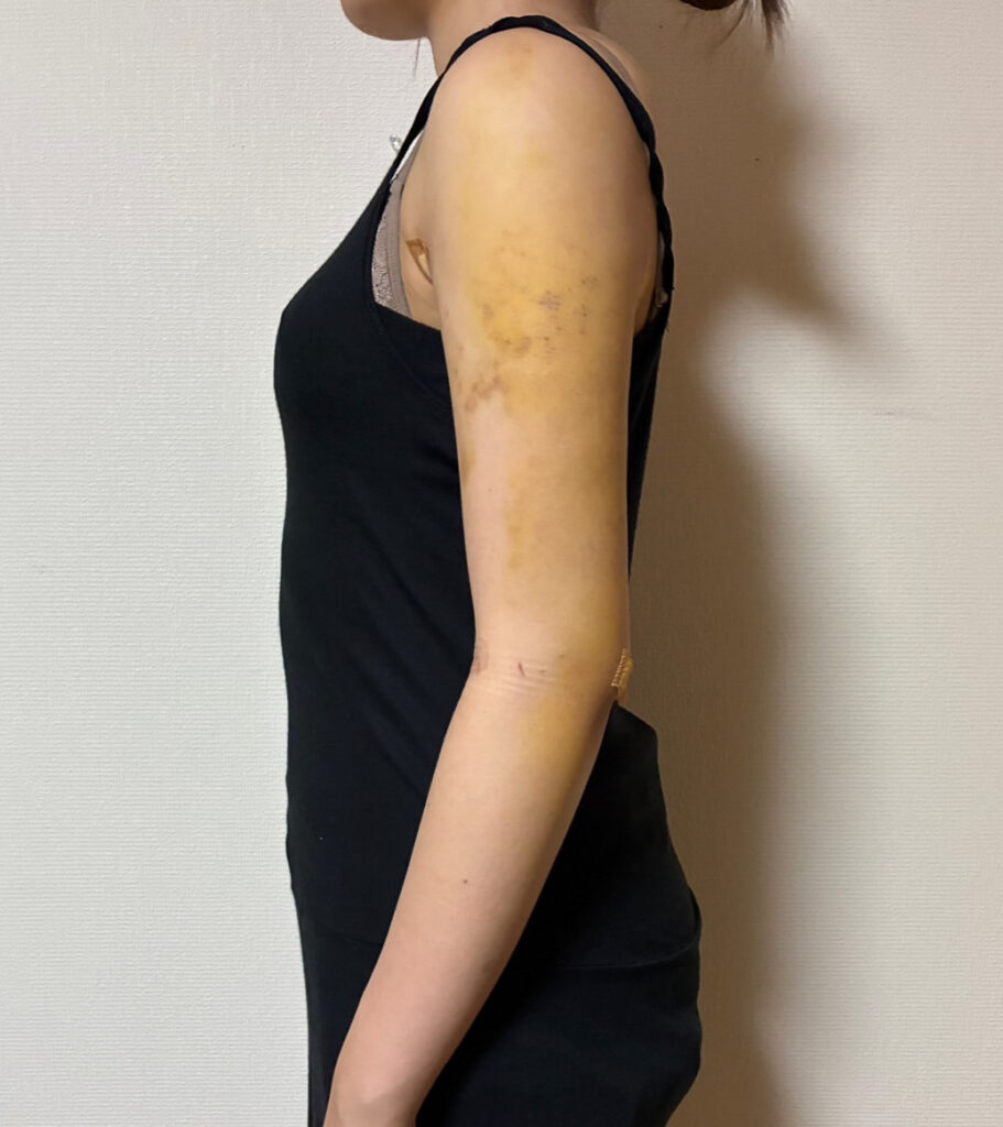 二の腕の脂肪吸引