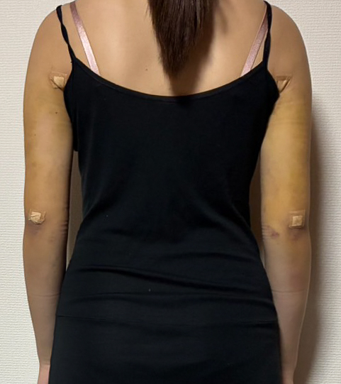 二の腕の脂肪吸引