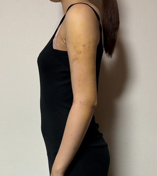 二の腕の脂肪吸引