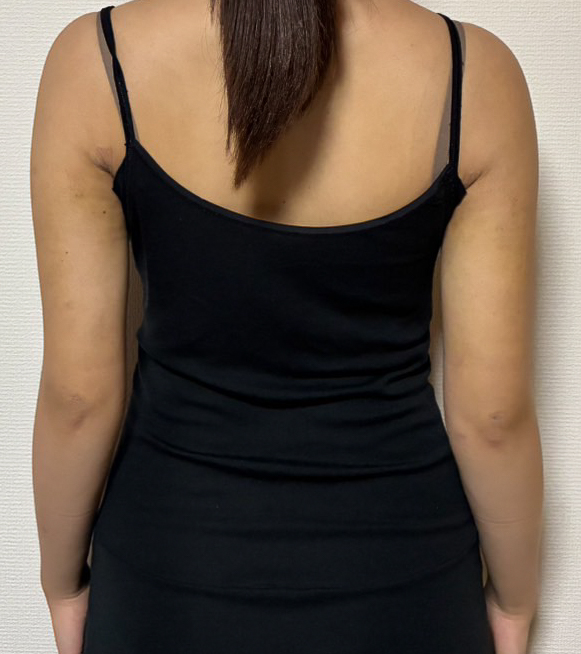 二の腕の脂肪吸引