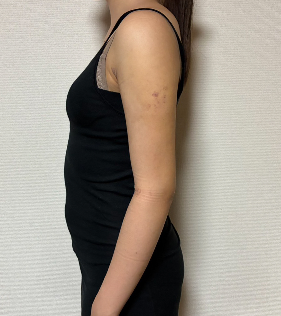 二の腕の脂肪吸引