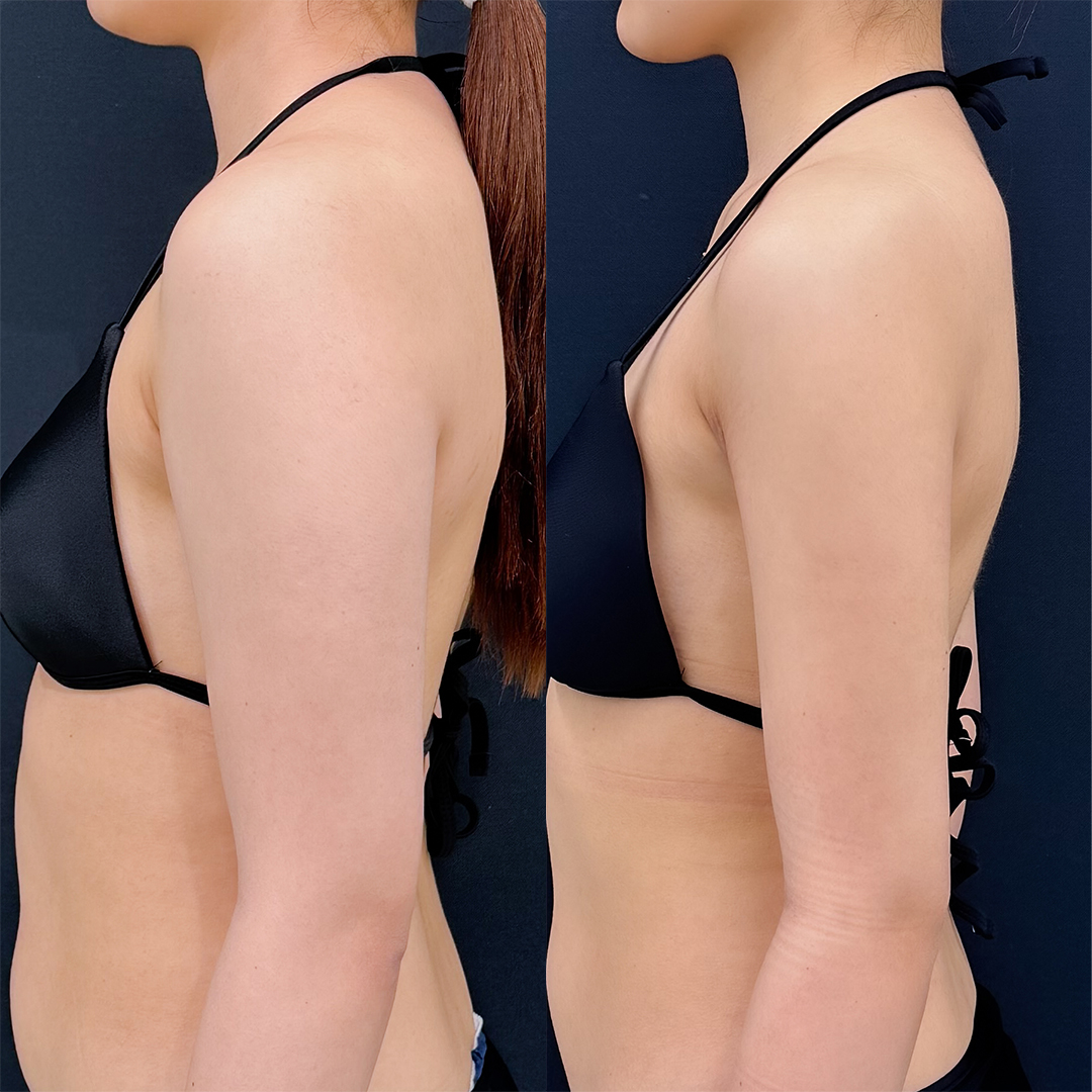 https://purelys-tokyo-clinic.com/wp/wp-content/uploads/2025/11/arm-Liposuction_Case-No.177.jpg