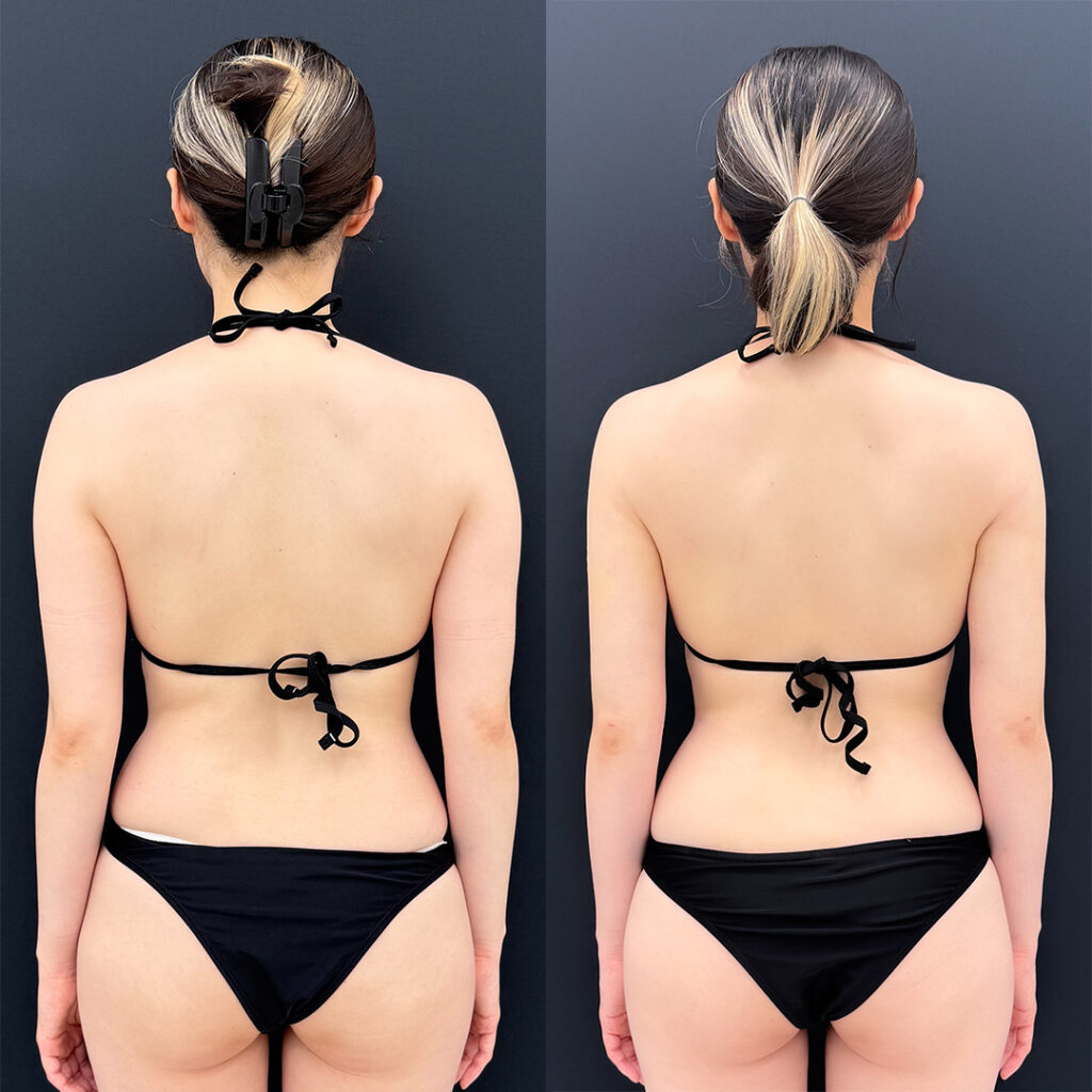 二の腕の脂肪吸引